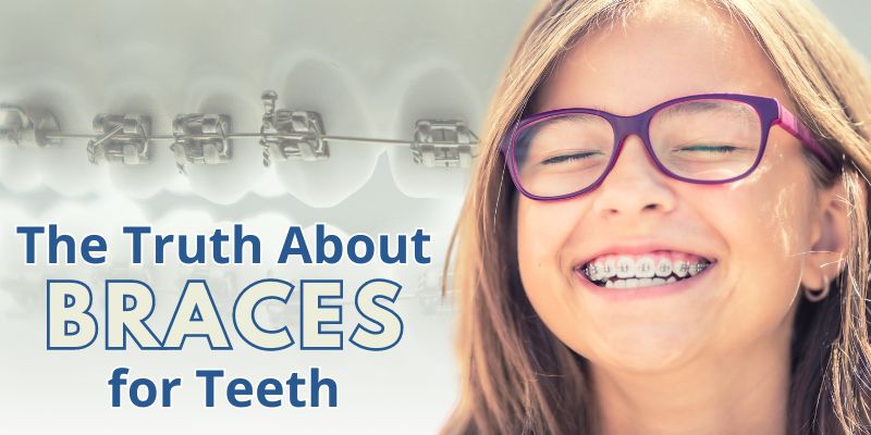 The Truth About Braces for Teeth